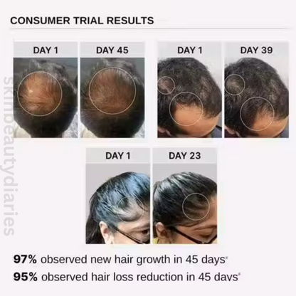 Ultimate Hair Growth Serum | Vitamin E, Dimethiconol, Amodimethicone & Cyclopentasiloxane | Fast Hair Growth & Hair Fall Control for Men & Women | 30mL (Pack of 1)